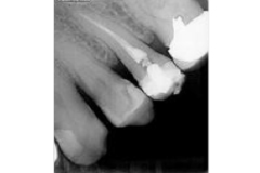 RADIOVISIOGRAPHIE INTRA-ORAL